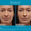 Radiesse Before and After Gallery | Luz MediSpa in Somers, NY