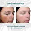 Before and After Results of VI Peel Precision plus tone, Texture, aging and photodamage | Luz MediSpa in Somers, NY