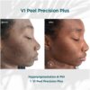 Before and After Results of VI Peel Precision Plus Hyperpigmentation and PIH | Luz MediSpa in Somers, NY
