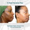 Before and After Results of VI Peel Precision Plus Hyperpigmentation, Texture and Tone | Luz MediSpa in Somers, NY