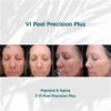 Before and After Results of VI Peel Precision Plus Pigment and Aging | Luz MediSpa in Somers, NY
