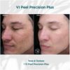 Before and After Results of VI Peel Precision Plus Tone and Texture | Luz MediSpa in Somers, NY