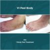Before and After Results of VI Peel Body PIH | Luz MediSpa in Somers, NY