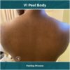 Treatment Results of VI Peel Body Peeling Process of a woman | Luz MediSpa in Somers, NY
