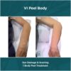 Before and After results of VI Peel Body Sun Damage and Scarring | Luz MediSpa in Somers, NY