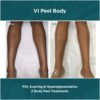 Before and After results of VI Peel Body PIH, Scarring and Hyperpigmentation | Luz MediSpa in Somers, NY