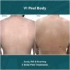 Before and After results of VI Peel Body Acne, PIE and Acne Scarring | Luz MediSpa in Somers, NY