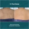 Before and After results of VI Peel Body PIH AND Acne Scarring | Luz MediSpa in Somers, NY