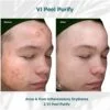 Before and After results of VI Peel Purify acne and post-Inflammatory erythema | Luz MediSpa in Somers, NY