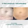 Before and After results of VI Peel Advanced + Microneedling Stretch Marks Treatment | Luz MediSpa in Somers, NY