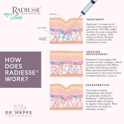 How Does Radiesse Work | Luz MediSpa in Somers, NY