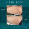 Before and After results of VI Peel Body Stretch Marks Treatment | Luz MediSpa in Somers, NY