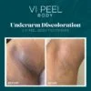 Before and After results of VI Peel Body Underarm discoloration treatment | Luz MediSpa in Somers, NY