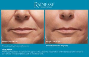 Female Facial Rejuvention Treatment Before and After Photos | Luz MediSpa in Somers, NY