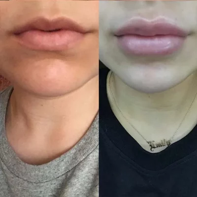 Luzmedispa-Product-Lip-Plumpers-gallery-ba
