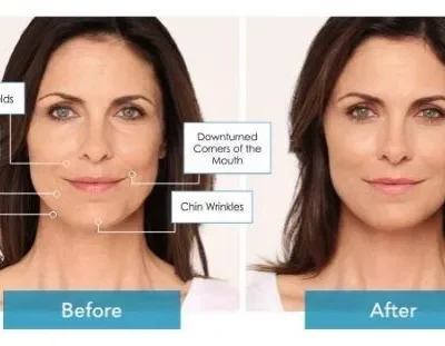 Radiesse Before and After | Luz MediSpa in Somers, NY