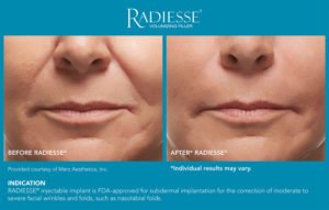 Face Rejuvenation | Luz MediSpa in Somers, NY