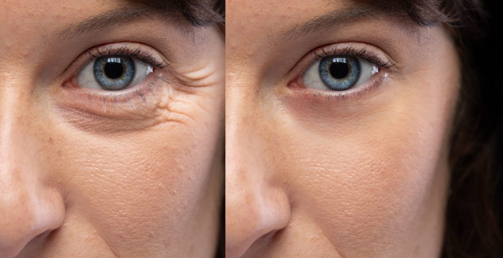 What is the Duration of Results for Under Eye Interventions? 6 Under Eye | Luz MediSpa in Somers, NY